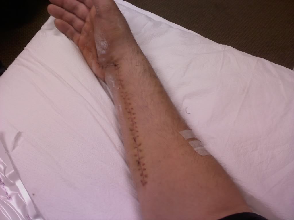 Name: StitchesRemoved.jpg
Views: 218
Size: 44.0 KB